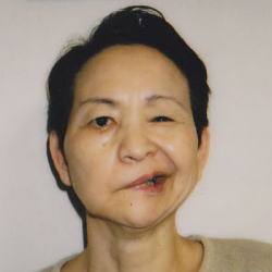 顔面麻痺治療例